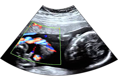 Fetal Echocardiography Ultrasound Image